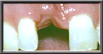 severe ridge defect after extracton