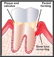 periodontal pocket with bone loss occurring