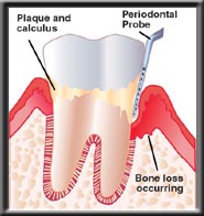 periodontal probe measuring pocket