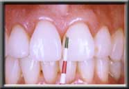 probe next to suclus