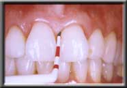 probing 3mm into healthy sulcus